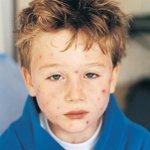Molluscum contagiosum la copii