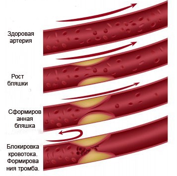 Tratamentul aterosclerozei cu remedii folclorice