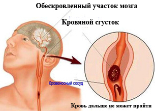 Tratamentul aterosclerozei cu remedii folclorice