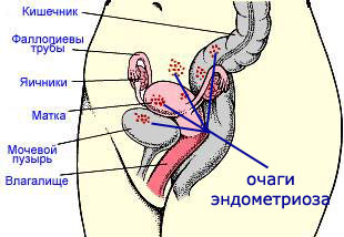 Endometrioza: tratament cu remedii folclorice