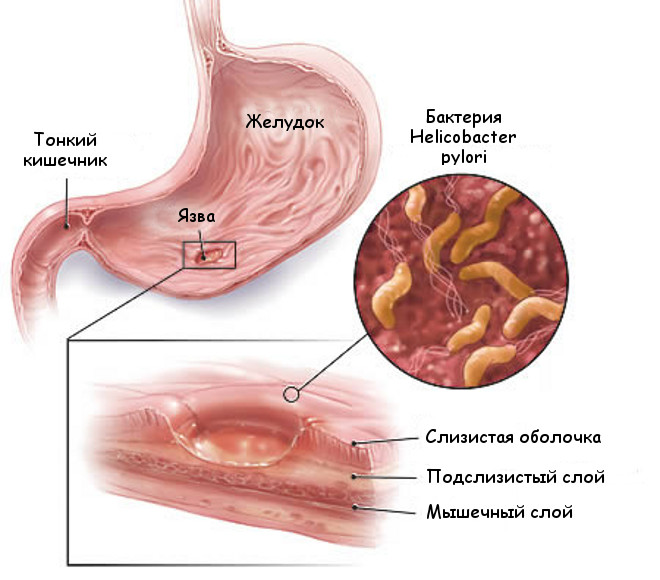 Tratamentul ulcerului gastric cu remedii folclorice