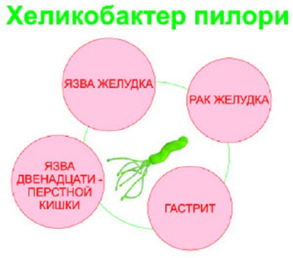 Tratamentul ulcerului gastric cu remedii folclorice