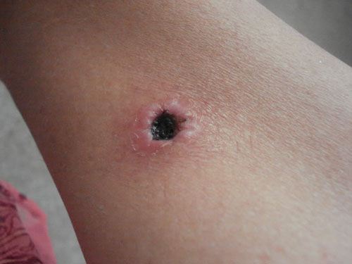 Ce este o fistula? Simptome, fotografii, tratamentul fistulei