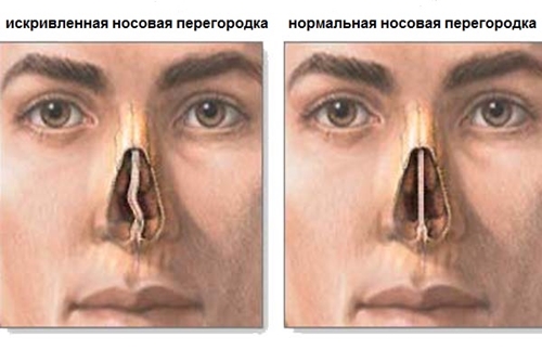 Cum se trateaza curbura septului nazal: chirurgie, corectie cu laser