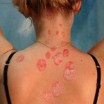 Cum se trateaza psoriazisul? Cum se trateaza psoriazisul?