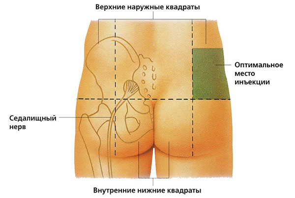 Cum să faceți o injecție intramusculară în fesă