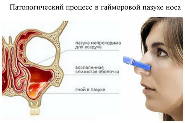 Brânză: de ce este important să începeți tratamentul la timp