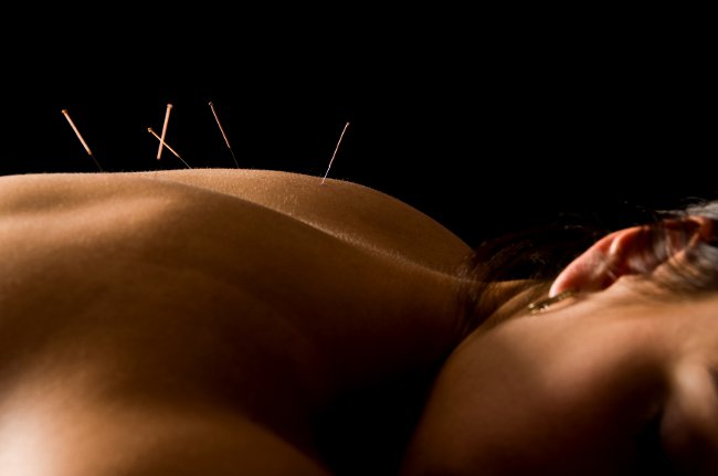 Tratamentul cu acupunctura