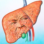 Tratamentul obezității hepatice: dieta și remedii populare