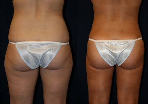 Liposucția abdomenului și a coapsei: recenzii, fotografii înainte și după