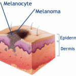 Melanomul pielii
