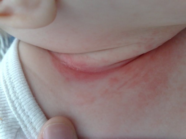 A apărut o erupție pe gâtul unui adult sau al unui copil? Principalele metode de tratament și prevenire a erupțiilor cutanate cervicale