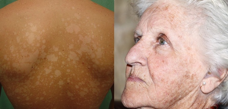 Pe piele o peeling