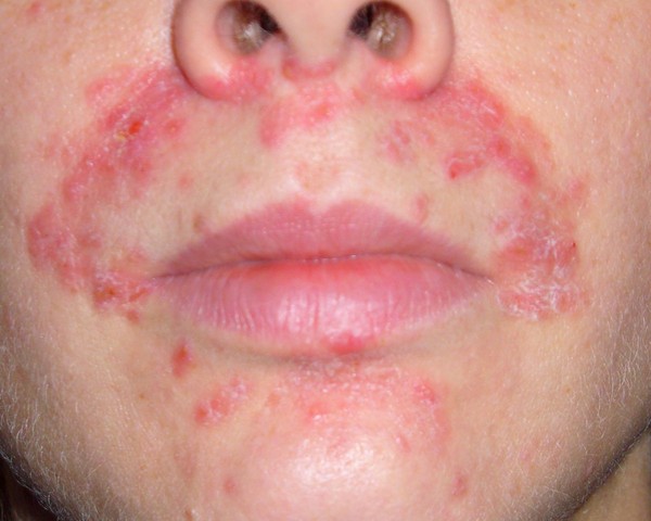 Pe piele o peeling