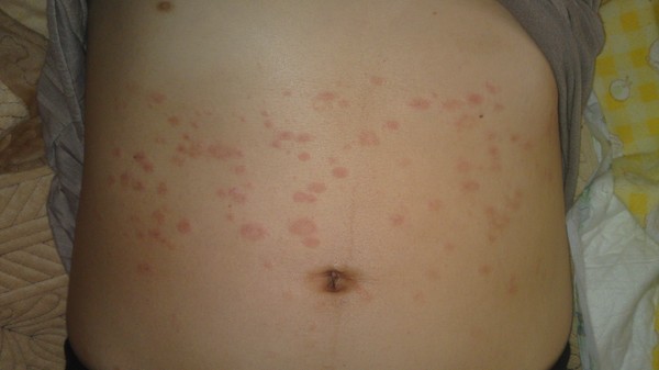 Pe piele o peeling