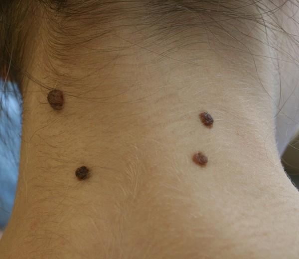 Pe piele o peeling